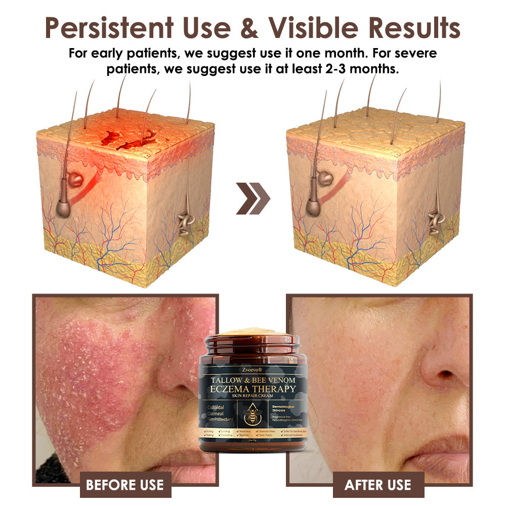 🏆❤️𝗚𝘂𝗮𝗿𝗮𝗻𝘁𝗲𝗲𝗱 𝗻𝗼 𝗿𝗲𝗰𝘂𝗿𝗿𝗲𝗻𝗰𝗲🌿Zvoevo® Tallow Bee Venom Skin Restoration Cream🐝Made in Australia🇦🇺