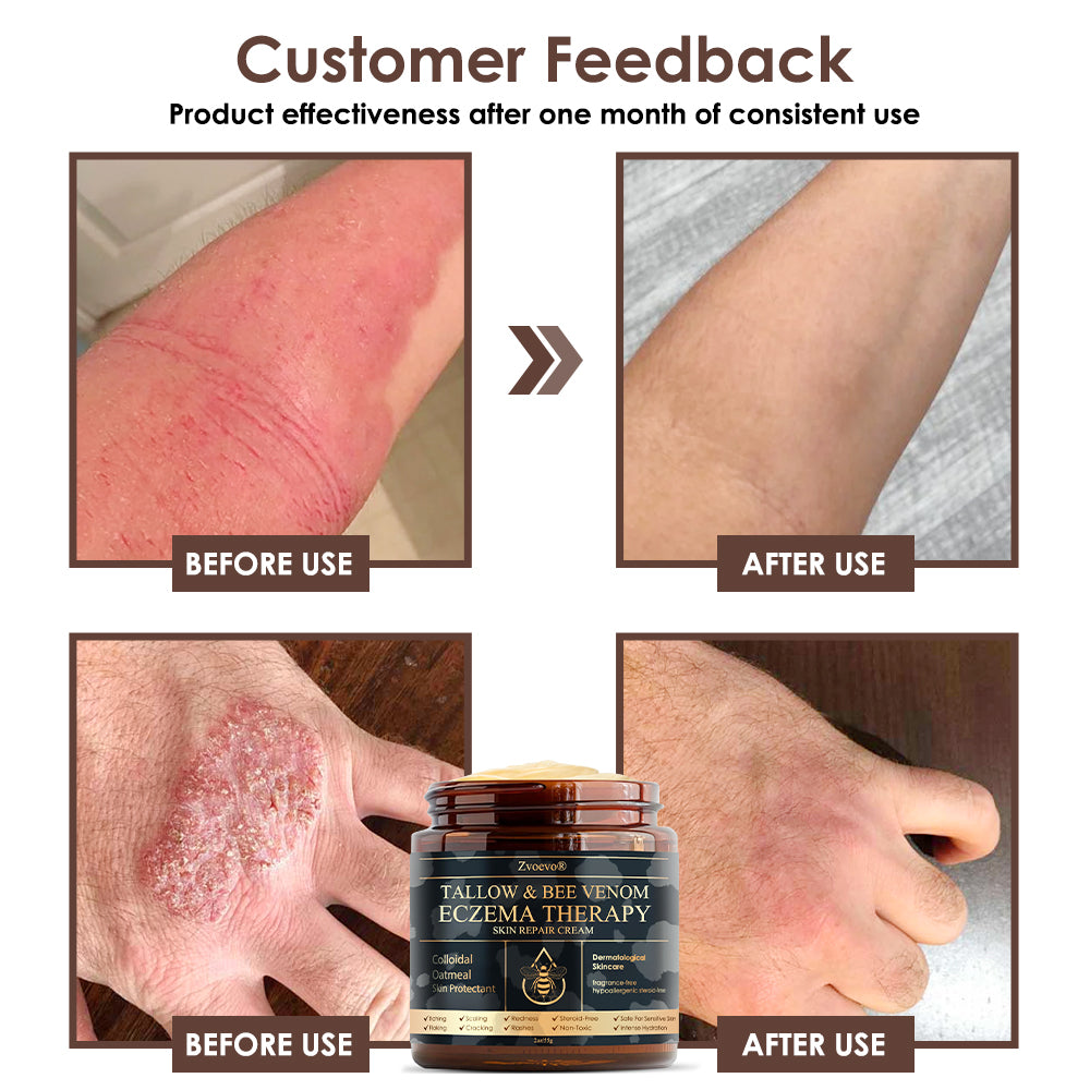 🏆❤️𝗚𝘂𝗮𝗿𝗮𝗻𝘁𝗲𝗲𝗱 𝗻𝗼 𝗿𝗲𝗰𝘂𝗿𝗿𝗲𝗻𝗰𝗲🌿Zvoevo® Tallow Bee Venom Skin Restoration Cream🐝Made in Australia🇦🇺