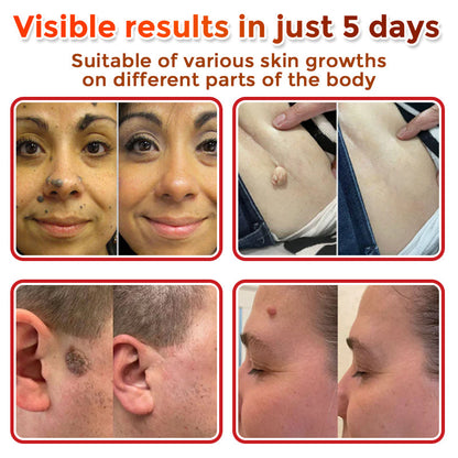 🇦🇺𝐆𝐅𝐎𝐔𝐊® 𝐌𝐢𝐜𝐫𝐨𝐍𝐞𝐞𝐝𝐥𝐞 𝐁𝐨𝐭𝐚𝐧𝐢𝐜 𝐒𝐤𝐢𝐧 𝐓𝐚𝐠 𝐑𝐞𝐦𝐨𝐯𝐚𝐥 Patch