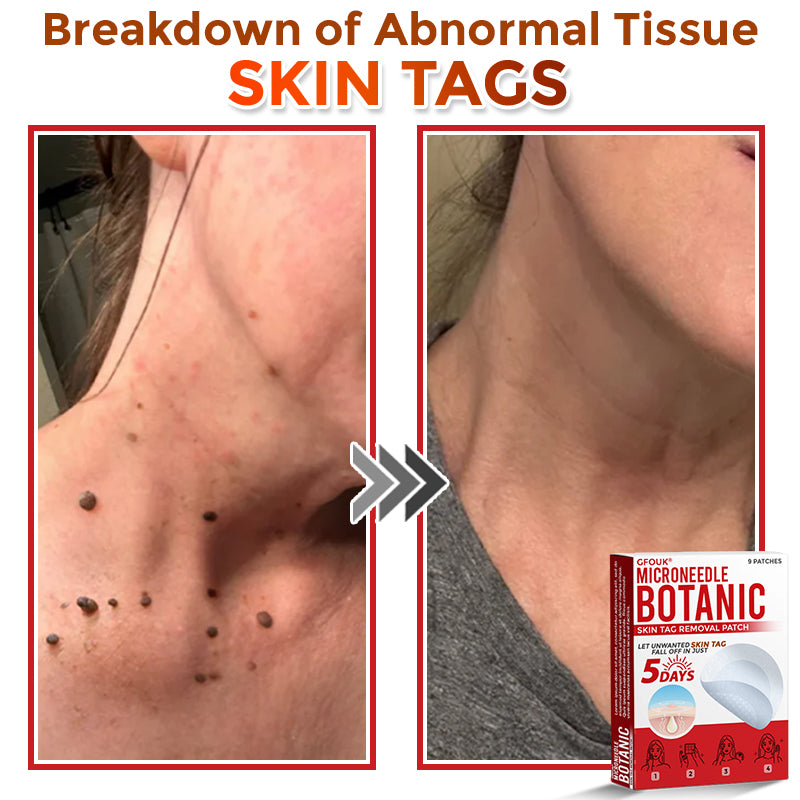 🇦🇺𝐆𝐅𝐎𝐔𝐊® 𝐌𝐢𝐜𝐫𝐨𝐍𝐞𝐞𝐝𝐥𝐞 𝐁𝐨𝐭𝐚𝐧𝐢𝐜 𝐒𝐤𝐢𝐧 𝐓𝐚𝐠 𝐑𝐞𝐦𝐨𝐯𝐚𝐥 Patch