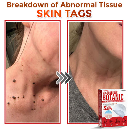 🇦🇺𝐆𝐅𝐎𝐔𝐊® 𝐌𝐢𝐜𝐫𝐨𝐍𝐞𝐞𝐝𝐥𝐞 𝐁𝐨𝐭𝐚𝐧𝐢𝐜 𝐒𝐤𝐢𝐧 𝐓𝐚𝐠 𝐑𝐞𝐦𝐨𝐯𝐚𝐥 Patch