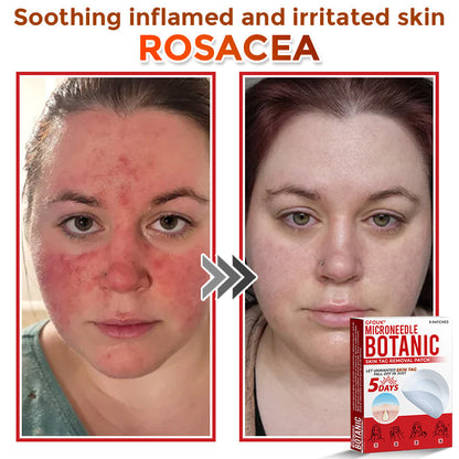 🇦🇺𝐆𝐅𝐎𝐔𝐊® 𝐌𝐢𝐜𝐫𝐨𝐍𝐞𝐞𝐝𝐥𝐞 𝐁𝐨𝐭𝐚𝐧𝐢𝐜 𝐒𝐤𝐢𝐧 𝐓𝐚𝐠 𝐑𝐞𝐦𝐨𝐯𝐚𝐥 Patch