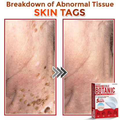 🇦🇺𝐆𝐅𝐎𝐔𝐊® 𝐌𝐢𝐜𝐫𝐨𝐍𝐞𝐞𝐝𝐥𝐞 𝐁𝐨𝐭𝐚𝐧𝐢𝐜 𝐒𝐤𝐢𝐧 𝐓𝐚𝐠 𝐑𝐞𝐦𝐨𝐯𝐚𝐥 Patch