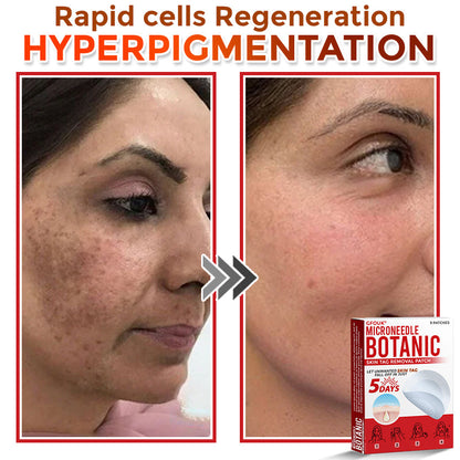 🇦🇺𝐆𝐅𝐎𝐔𝐊® 𝐌𝐢𝐜𝐫𝐨𝐍𝐞𝐞𝐝𝐥𝐞 𝐁𝐨𝐭𝐚𝐧𝐢𝐜 𝐒𝐤𝐢𝐧 𝐓𝐚𝐠 𝐑𝐞𝐦𝐨𝐯𝐚𝐥 Patch