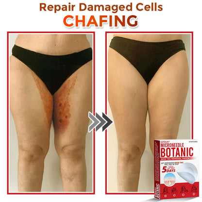 🇦🇺𝐆𝐅𝐎𝐔𝐊® 𝐌𝐢𝐜𝐫𝐨𝐍𝐞𝐞𝐝𝐥𝐞 𝐁𝐨𝐭𝐚𝐧𝐢𝐜 𝐒𝐤𝐢𝐧 𝐓𝐚𝐠 𝐑𝐞𝐦𝐨𝐯𝐚𝐥 Patch