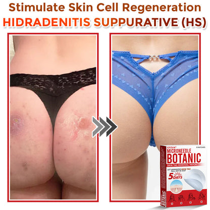 🇦🇺𝐆𝐅𝐎𝐔𝐊® 𝐌𝐢𝐜𝐫𝐨𝐍𝐞𝐞𝐝𝐥𝐞 𝐁𝐨𝐭𝐚𝐧𝐢𝐜 𝐒𝐤𝐢𝐧 𝐓𝐚𝐠 𝐑𝐞𝐦𝐨𝐯𝐚𝐥 Patch
