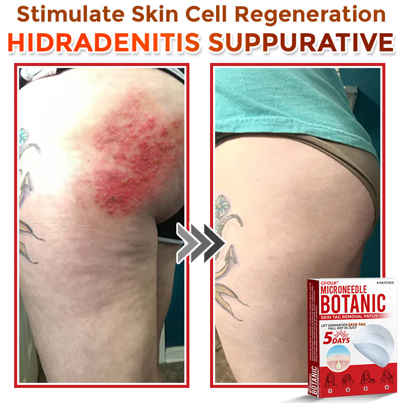 🇦🇺𝐆𝐅𝐎𝐔𝐊® 𝐌𝐢𝐜𝐫𝐨𝐍𝐞𝐞𝐝𝐥𝐞 𝐁𝐨𝐭𝐚𝐧𝐢𝐜 𝐒𝐤𝐢𝐧 𝐓𝐚𝐠 𝐑𝐞𝐦𝐨𝐯𝐚𝐥 Patch