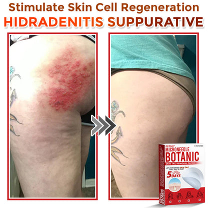 🇦🇺𝐆𝐅𝐎𝐔𝐊® 𝐌𝐢𝐜𝐫𝐨𝐍𝐞𝐞𝐝𝐥𝐞 𝐁𝐨𝐭𝐚𝐧𝐢𝐜 𝐒𝐤𝐢𝐧 𝐓𝐚𝐠 𝐑𝐞𝐦𝐨𝐯𝐚𝐥 Patch