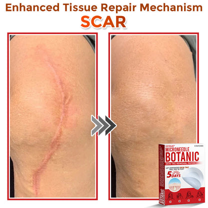 🇦🇺𝐆𝐅𝐎𝐔𝐊® 𝐌𝐢𝐜𝐫𝐨𝐍𝐞𝐞𝐝𝐥𝐞 𝐁𝐨𝐭𝐚𝐧𝐢𝐜 𝐒𝐤𝐢𝐧 𝐓𝐚𝐠 𝐑𝐞𝐦𝐨𝐯𝐚𝐥 Patch