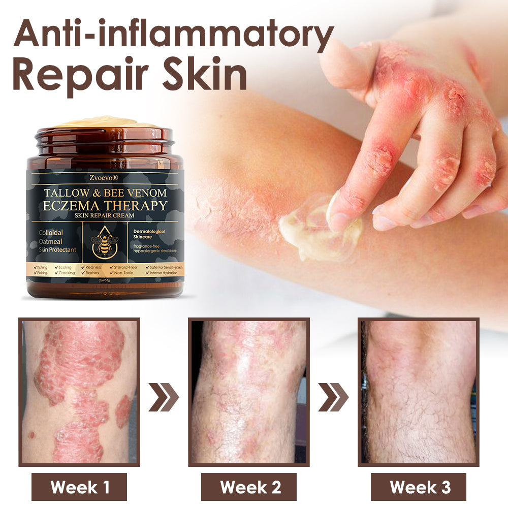 🏆❤️𝗚𝘂𝗮𝗿𝗮𝗻𝘁𝗲𝗲𝗱 𝗻𝗼 𝗿𝗲𝗰𝘂𝗿𝗿𝗲𝗻𝗰𝗲🌿Zvoevo® Tallow Bee Venom Skin Restoration Cream🐝Made in Australia🇦🇺
