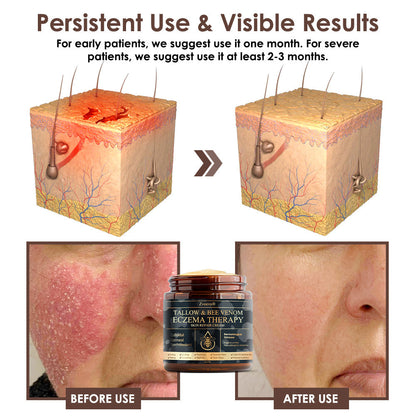 🏆❤️𝗚𝘂𝗮𝗿𝗮𝗻𝘁𝗲𝗲𝗱 𝗻𝗼 𝗿𝗲𝗰𝘂𝗿𝗿𝗲𝗻𝗰𝗲🌿Zvoevo® Tallow Bee Venom Skin Restoration Cream🐝Made in Australia🇦🇺